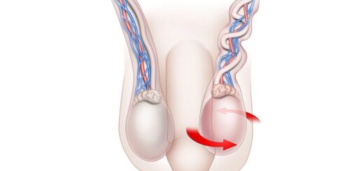 Torsion du testicule, comprendre le mal