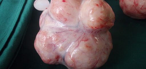 Fibrome Utérin : symptômes, causes, opération
