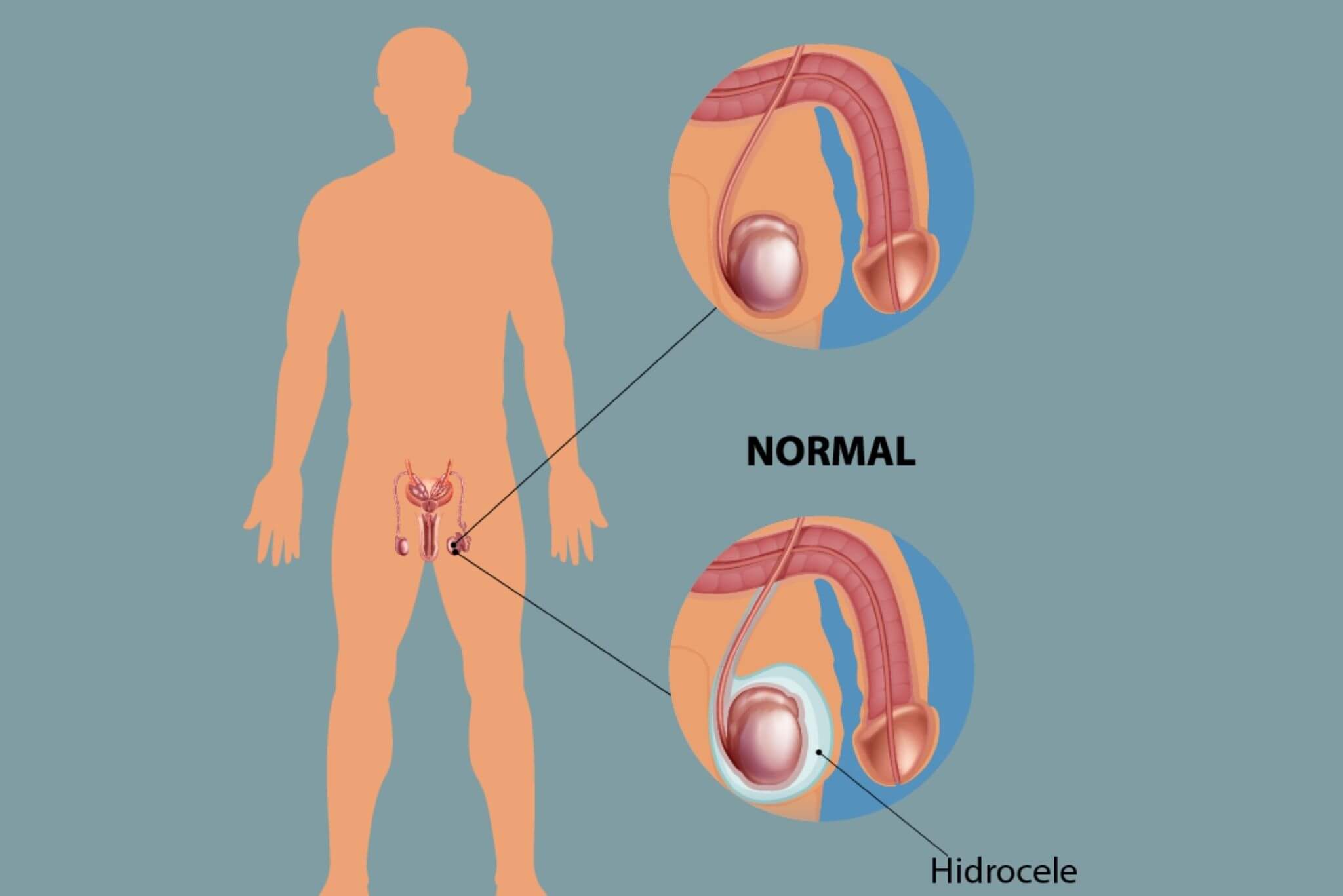 Remède Naturel Hydrocèle Testiculaire