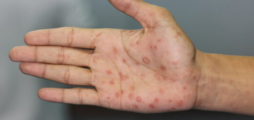 Remède Naturel Syphilis