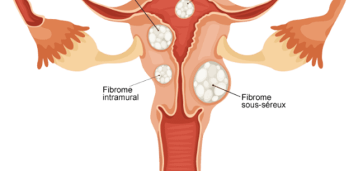 Se Débarrasser De Fibrome Naturellement