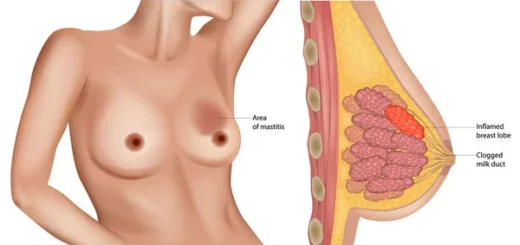 comment le cancer du sein se guerir t elle?