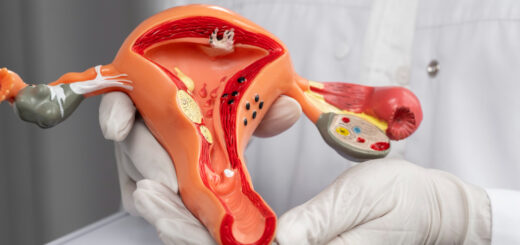 Remède Naturel Kyste Ovarien