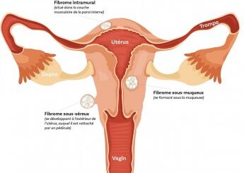 Types de Fibrome Traitements