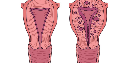 Endométriose Définition Causes Symptômes