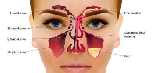 Remède naturel Sinusite, Traitement de l'Infection des Sinus