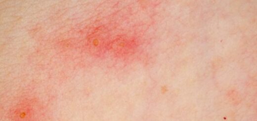 Comment éviter les mycoses? la Vaginite?