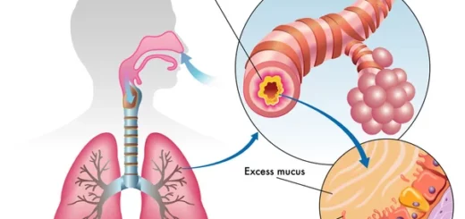 Bronchopneumopathie Maladie Respiratoire Chronique