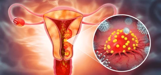 Remède Naturel Contre le Cancer des Ovaires