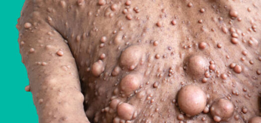 La fibromatose palmaire guérison traditionnelle