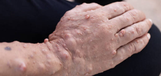 Fibromatose Palmaire en Général : Solution Naturelle