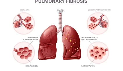 Fibrose Pulmonaire Remède Africaine Guérison Naturelle