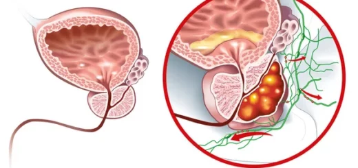 Cancer de la Prostate- Plantes pour Guérir la Prostate