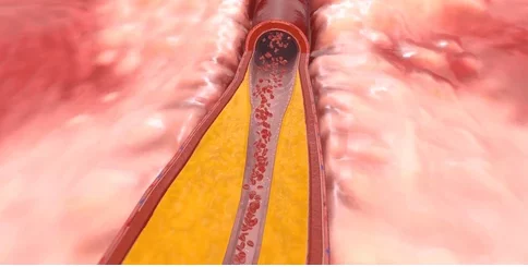 Hypercholestérolémie Remède Excès de Cholestérol