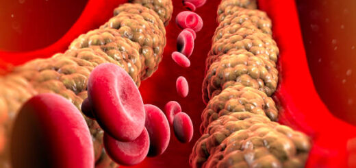 Hypercholestérolémie Traitement Naturel Excès de Cholestérol