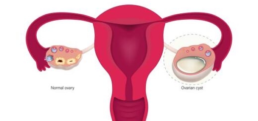Causes et conséquences des kystes ovariens