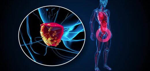 Remède Africaine Cancer de la Prostate