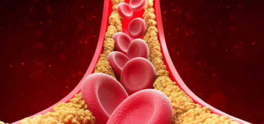 Hypercholestérolémie- Comment réduire le taux de cholestérol dans l'organisme