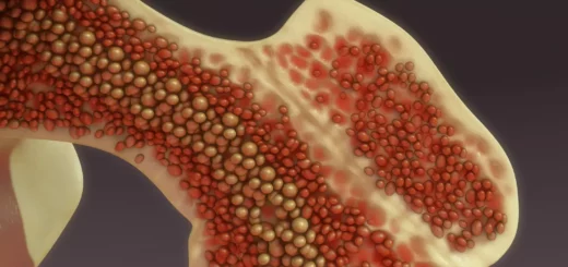 Comment Soigner Aplasie Médullaire Efficacement?