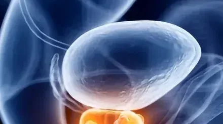 Cancer de la Prostate Remède Naturel