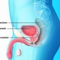 Traitement à base de Plantes Contre Cancer Prostate