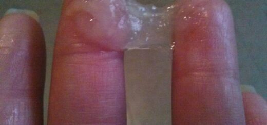 Troubles de la Glaire Cervicale Traitements