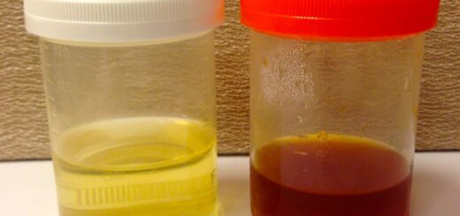 Hématurie: définition, causes, symptômes et Traitement