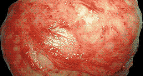 Fibrome Quel Remède Sûr? Traitement d'Un Fibrome Utérin