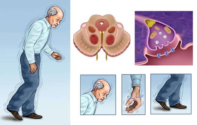 895 La maladie de Parkinson: définition, causes, symptômes, et traitement naturel