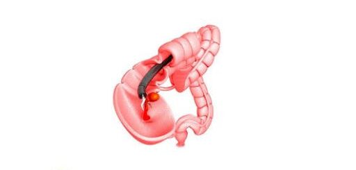 Polype du Colon Recette Naturelle