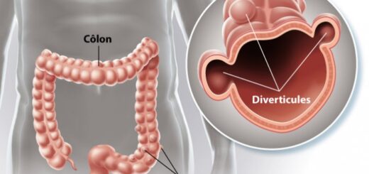 La diverticulose du colon : Causes et Traitement Naturel