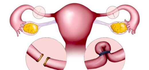 Phimosis tubaire Trompes de Fallope : Remède Naturel