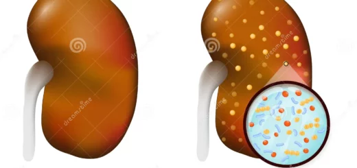 La pyélonéphrite: symptômes et traitement naturel