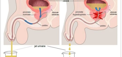 Adénome de la prostate traitement naturel