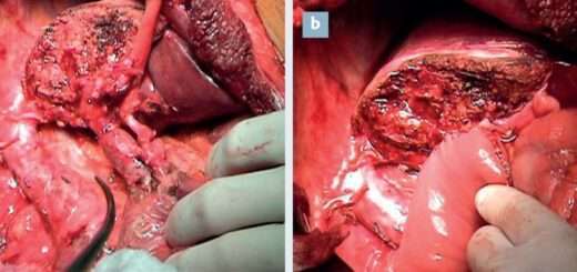 Cholangiocarcinome définition et traitement naturel