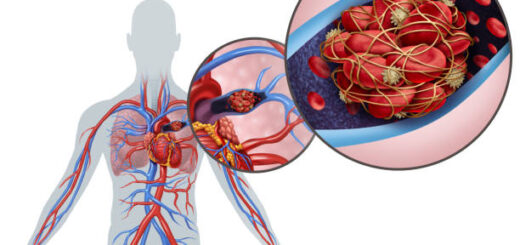 Comment Soigner une Embolie Pulmonaire