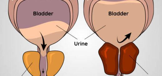 Adénome de la Prostate ou l'Hypertrophie Traitement Naturel