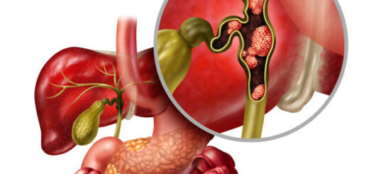 Cholangiocarcinome : Définition Causes et Traitement naturel