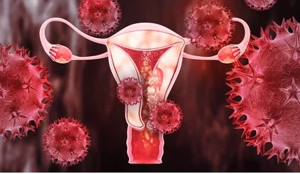 Le Cancer De l'Utérus Définition Causes Et Traitement Naturel