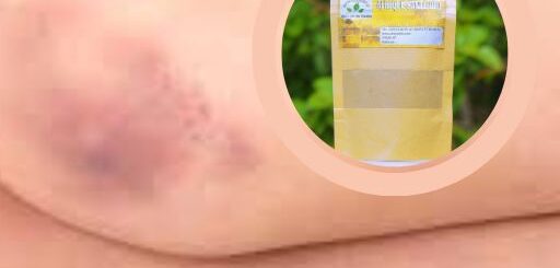 La thrombocytopénie causes et traitement naturel