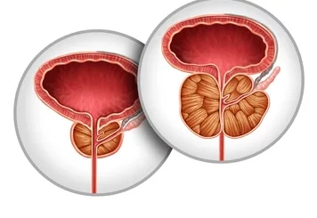 Soigner le Cancer de la Prostate : Remède Naturel