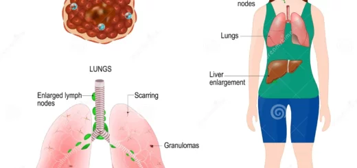 La Sarcoïdose: Définition Causes Et Traitement Naturel de La Sarcoïdose