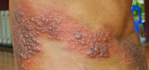 Zona: Causes, symptômes et traitement naturel de la maladie du Zona