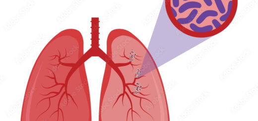 La tuberculose information symptômes et traitement