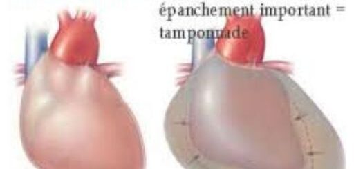 La péricardite causes et symptômes