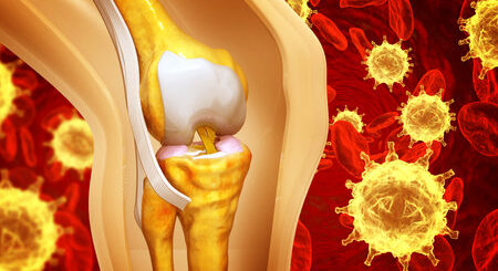 Définition, Cancer des os et soin naturel
