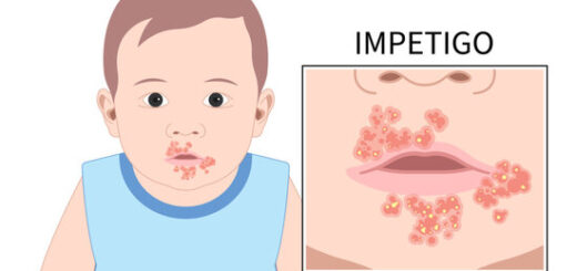 L'impétigo soin naturel
