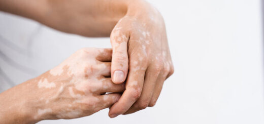 Remède Naturel Contre Le Vitiligo