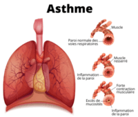 Recette Naturelle Contre l'Asthme