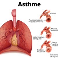 Recette Naturelle Contre l'Asthme